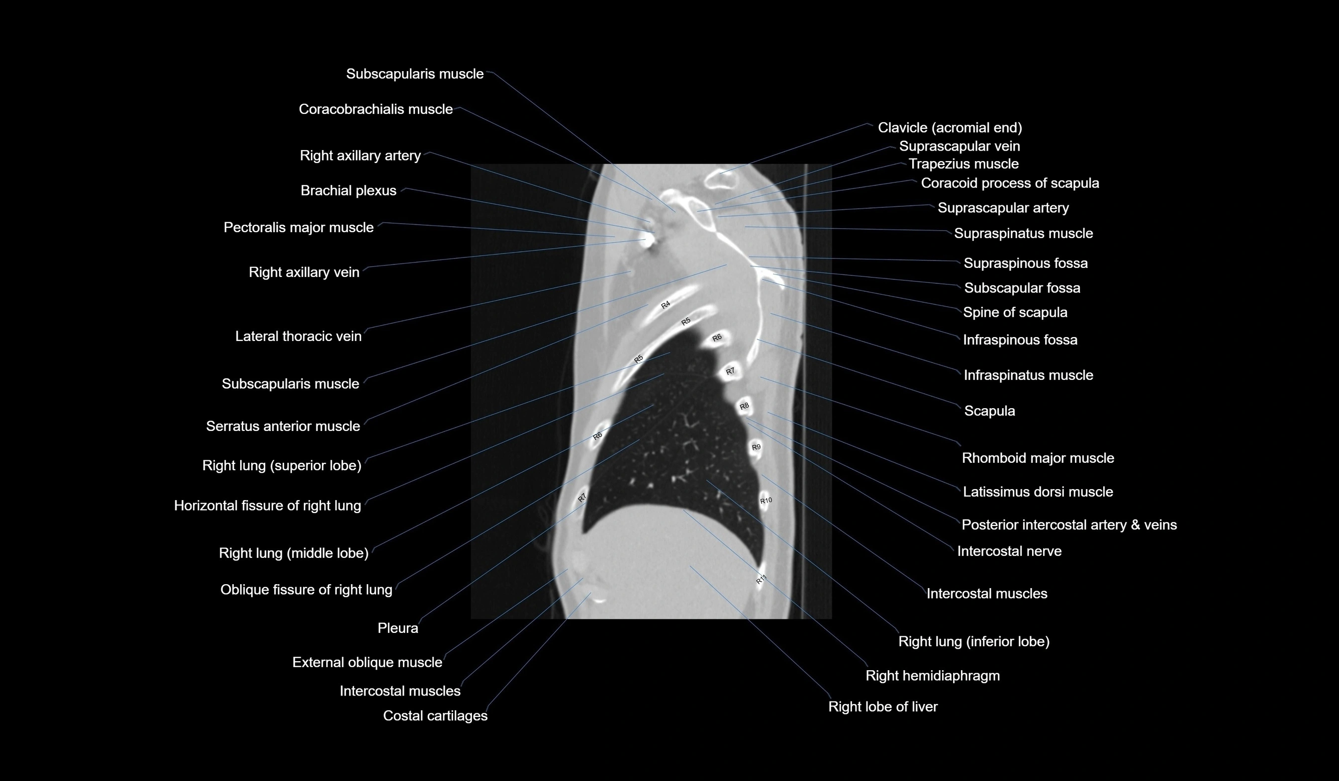 CT chest (thorax) lung window labelled sagittal cross sectional anatomy radiology image-00024.webp